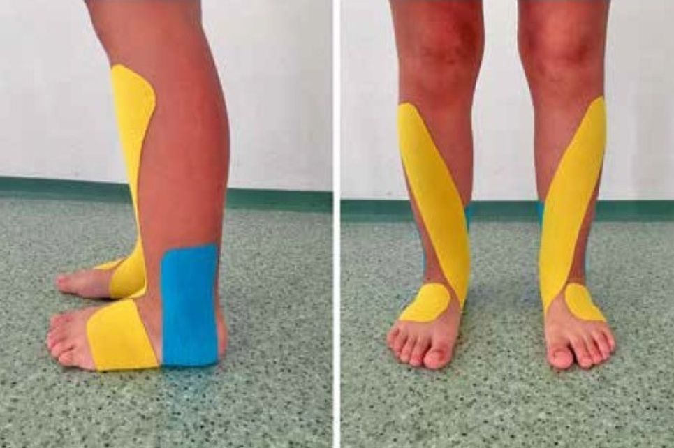 Hlavní obrázek - Vliv kineziotejpování a kinezioterapie na dynamické parametry chůze u dětí s hyperpronačním syndromem